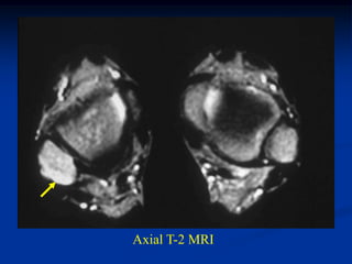 Axial T-2 MRI
 
