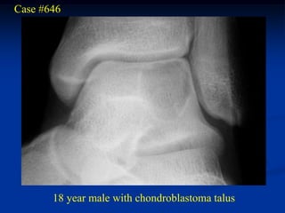 Case #646




       18 year male with chondroblastoma talus
 