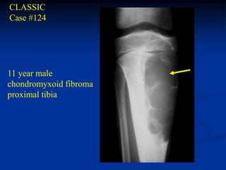 CLASSIC
Case #124




11 year male
chondromyxoid fibroma
proximal tibia
 