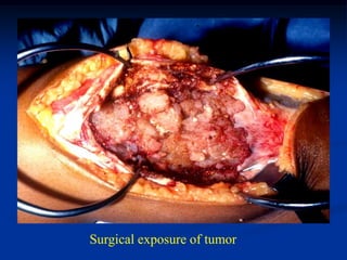 Surgical exposure of tumor
 
