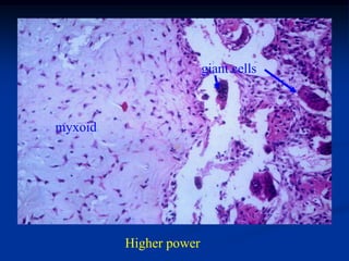 giant cells



myxoid




         Higher power
 