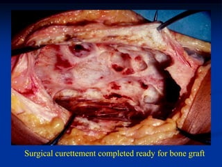 Surgical curettement completed ready for bone graft
 
