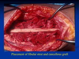 Placement of fibular strut and cancellous graft
 