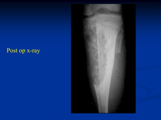 Post op x-ray
 