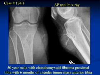 Case # 124.1                    AP and lat x-ray




  50 year male with chondromyxoid fibroma proximal
tibia with 6 months of a tender tumor mass anterior tibia
 