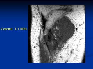 Coronal T-1 MRI
 