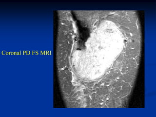 Coronal PD FS MRI
 