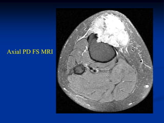 Axial PD FS MRI
 