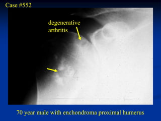Case #552

              degenerative
              arthritis




   70 year male with enchondroma proximal humerus
 