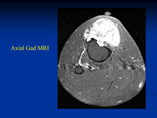 Axial Gad MRI
 