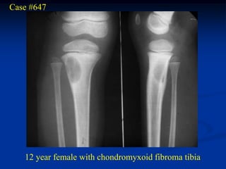 Case #647




   12 year female with chondromyxoid fibroma tibia
 