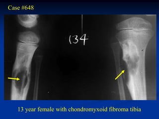 Case #648




   13 year female with chondromyxoid fibroma tibia
 