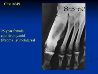 Case #649




25 year female
chondromyxoid
fibroma 1st metatarsal
 