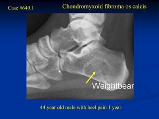 Case #649.1             Chondromyxoid fibroma os calcis




              44 year old male with heel pain 1 year
 