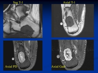 Sag T-1          Axial T-1




Axial PD       Axial Gad
 