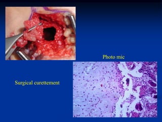 Photo mic



Surgical curettement
 