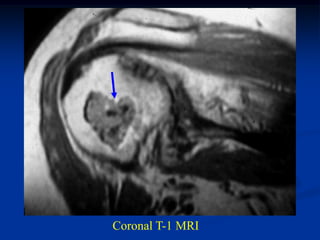Coronal T-1 MRI
 