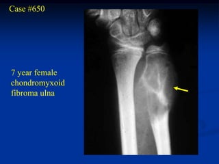 Case #650




7 year female
chondromyxoid
fibroma ulna
 