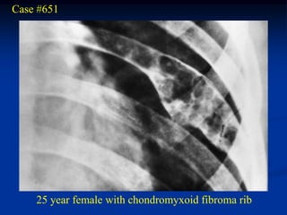 Case #651




    25 year female with chondromyxoid fibroma rib
 