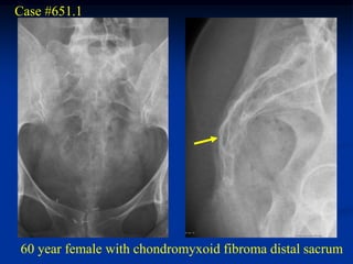 Case #651.1




60 year female with chondromyxoid fibroma distal sacrum
 