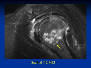 Sagittal T-2 MRI
 