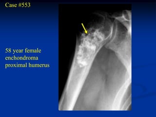 Case #553




58 year female
enchondroma
proximal humerus
 