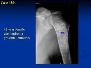 Case #554




 42 year female
 enchondroma        tumor
 proximal humerus
 