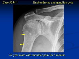 Case #554.1           Enchondroma and ganglion cyst




    47 year male with shoulder pain for 6 months
 