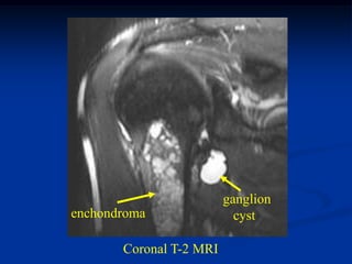 ganglion
enchondroma                cyst

       Coronal T-2 MRI
 