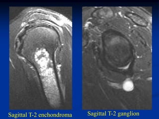 Sagittal T-2 enchondroma   Sagittal T-2 ganglion
 
