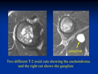 ganglion

Two different T-2 axial cuts showing the enchondroma
       and the right cut shows the ganglion
 