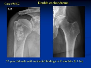 Case #554.2                Double enchondroma




 52 year old male with incidental findings in R shoulder & L hip
 