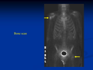 Bone scan
 