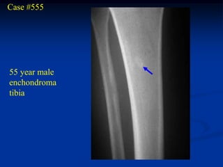 Case #555




55 year male
enchondroma
tibia
 