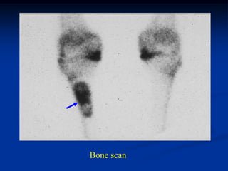 Bone scan
 