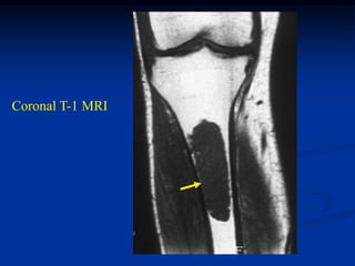 Coronal T-1 MRI
 