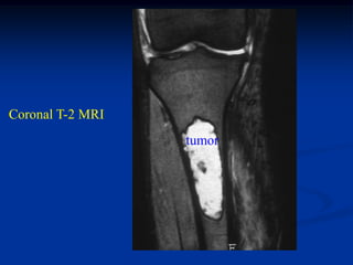 Coronal T-2 MRI
                  tumor
 