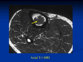 Axial T-1 MRI
 