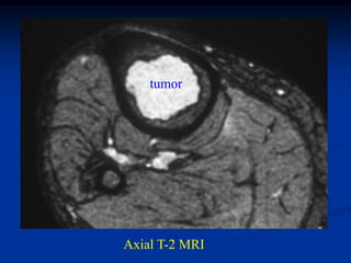 tumor




Axial T-2 MRI
 