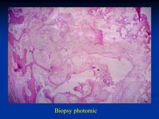 Biopsy photomic
 