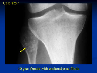 Case #557




        40 year female with enchondroma fibula
 
