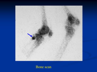 Bone scan
 