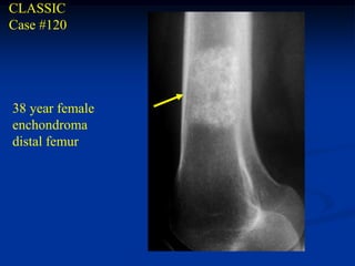 CLASSIC
Case #120




38 year female
enchondroma
distal femur
 
