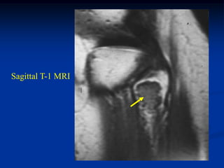 Sagittal T-1 MRI
 