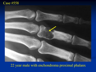 Case #558




    22 year male with enchondroma proximal phalanx
 