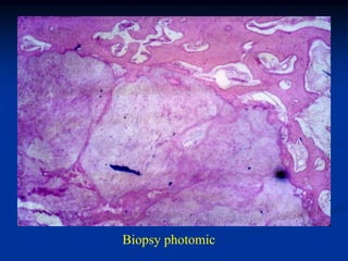 Biopsy photomic
 
