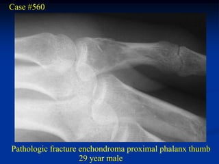 Case #560




Pathologic fracture enchondroma proximal phalanx thumb
                    29 year male
 