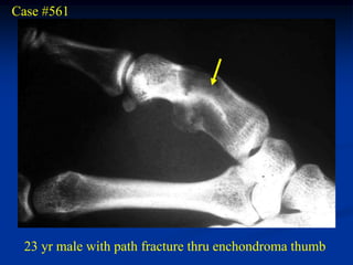 Case #561




 23 yr male with path fracture thru enchondroma thumb
 