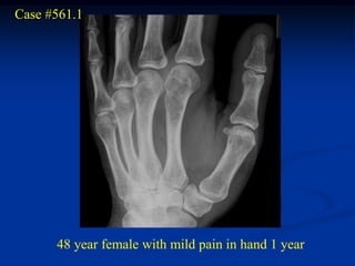 Case #561.1




      48 year female with mild pain in hand 1 year
 