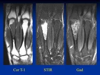 Cor T-1   STIR   Gad
 